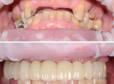 Upper & lower full arch implant
