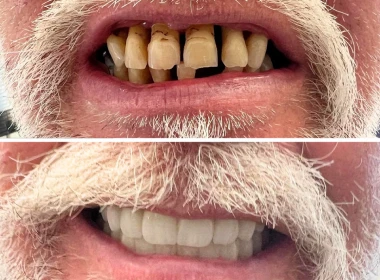 failing teeth to a fixed teeth