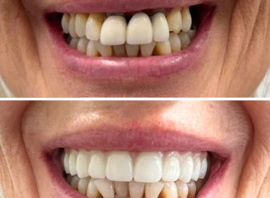 fixed teeth clients results