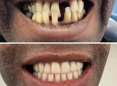 Single arch restoration