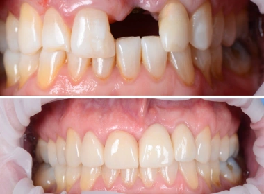 Single Implants Client Results