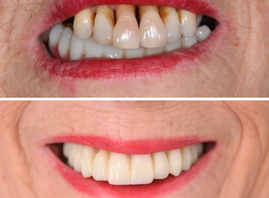 Full mouth rehabilitation